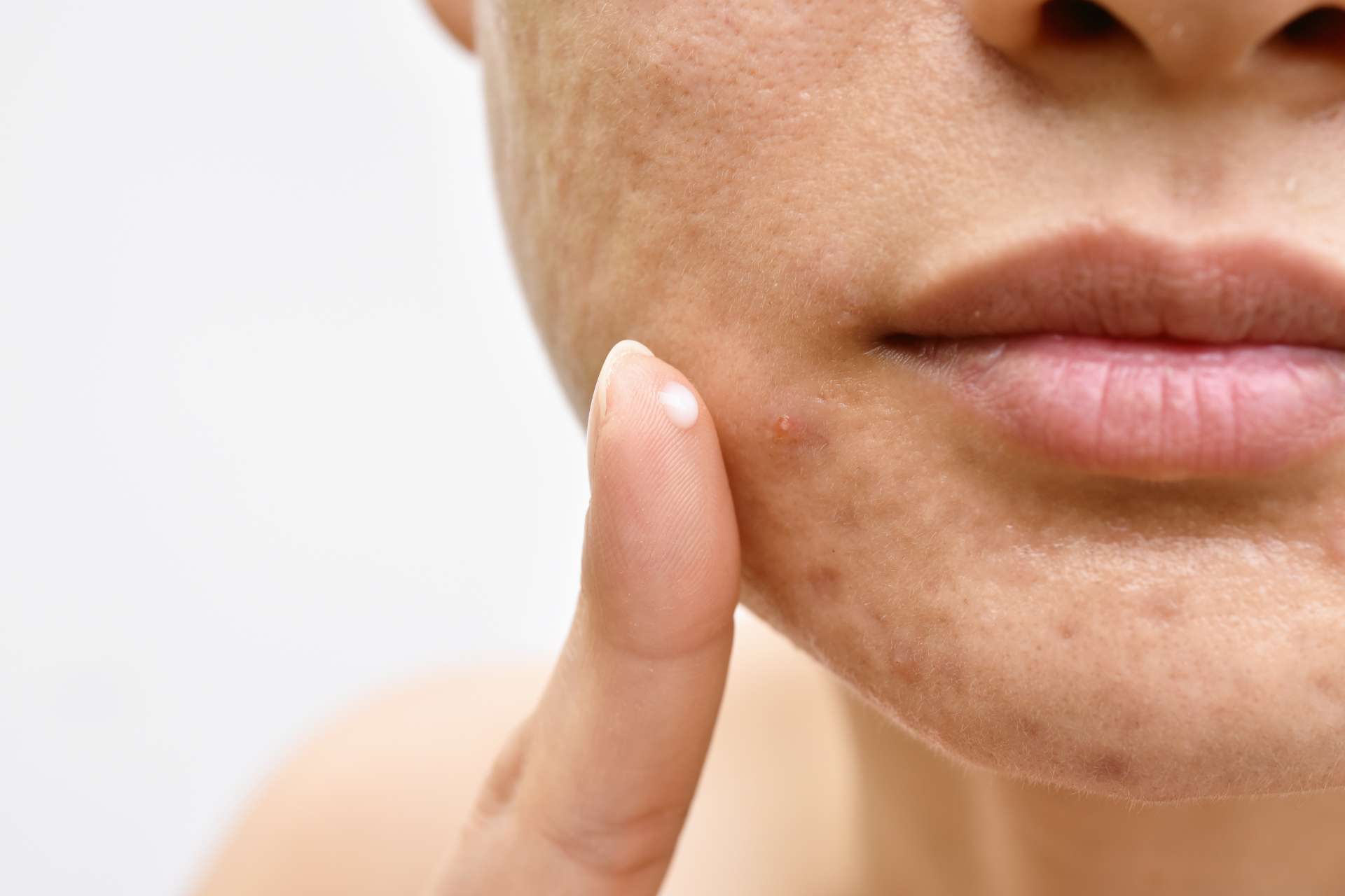 Acne Scars