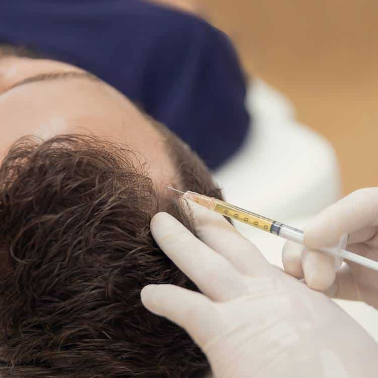 PRP Injections for Hair Follicles