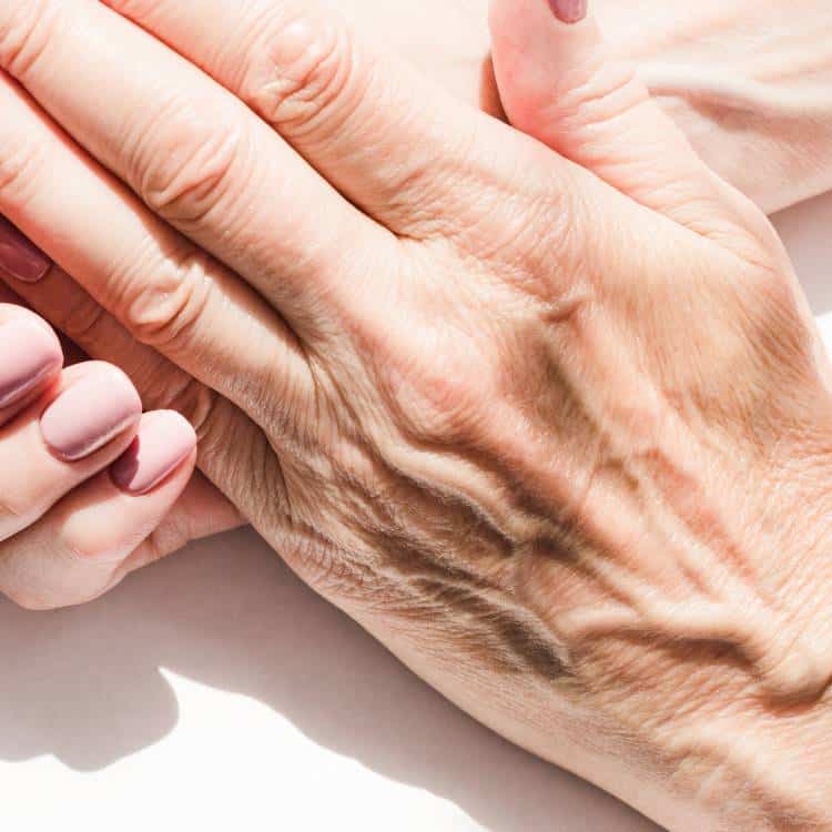 Removing wrinkles on the hand using PRP.