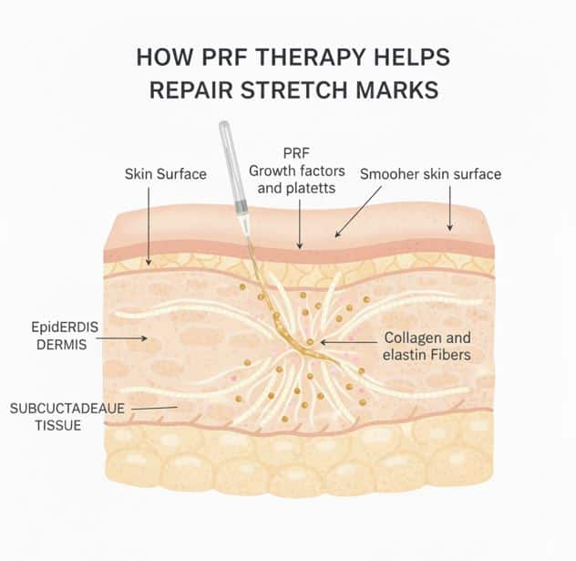 Infographic showing how PRF therapy repairs stretch marks.